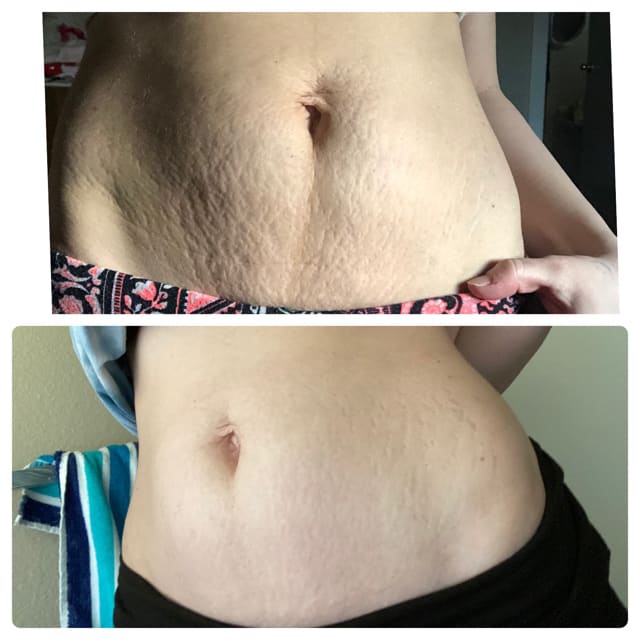 Stretch Marks Reduction Injector Maya